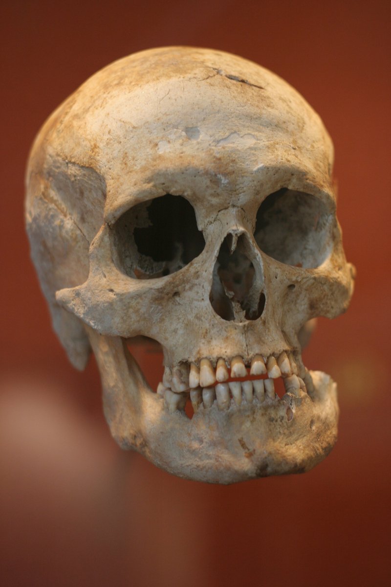 a human skull with multiple teeth is shown