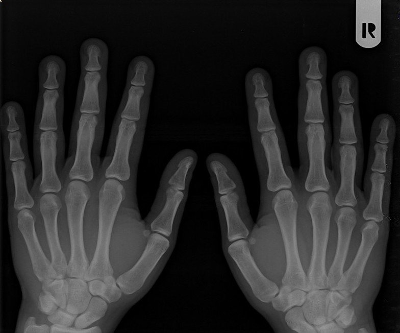 hand x - ray showing both bones in black and white