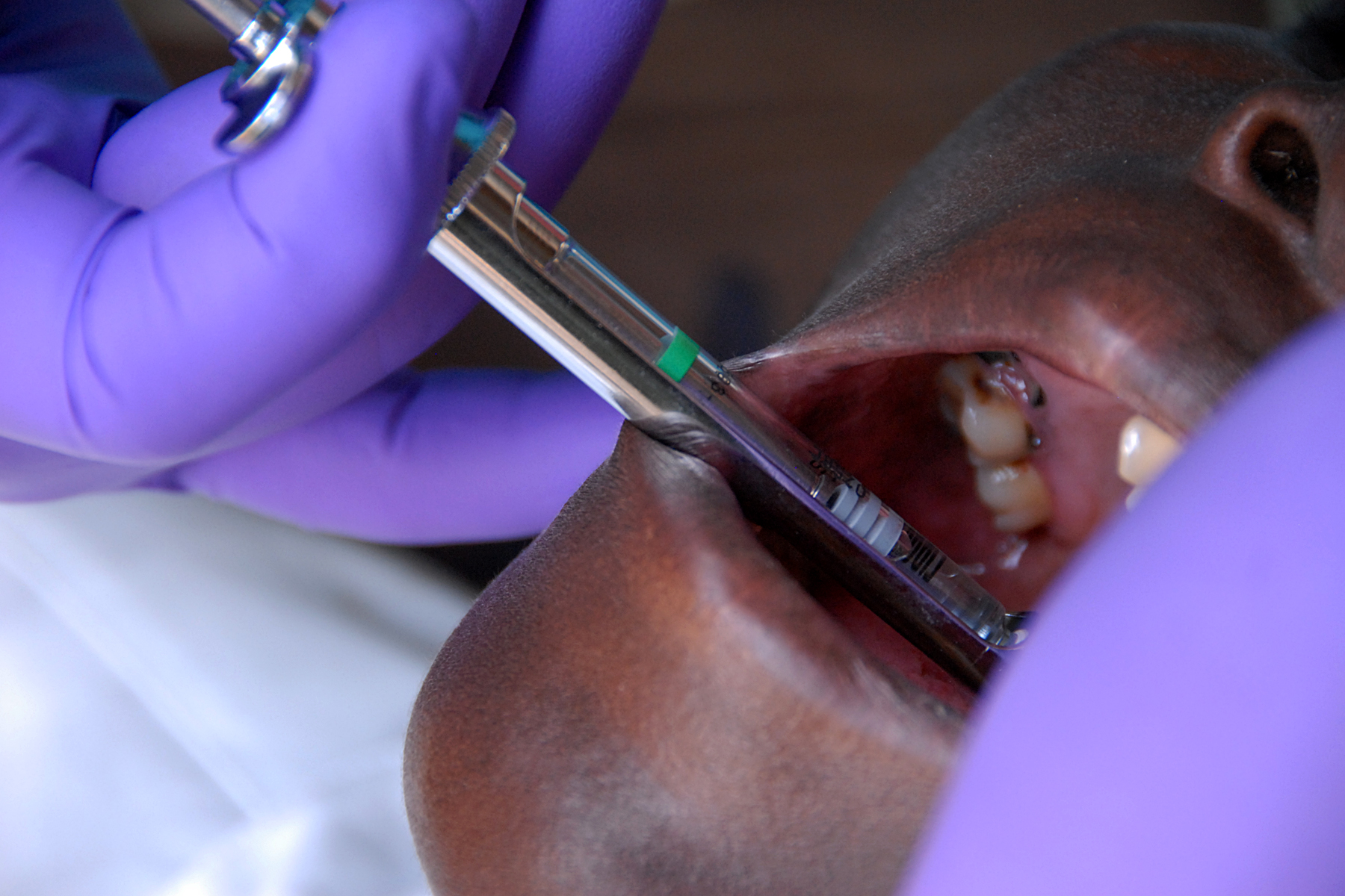 close up of an operation performed on a man's teeth