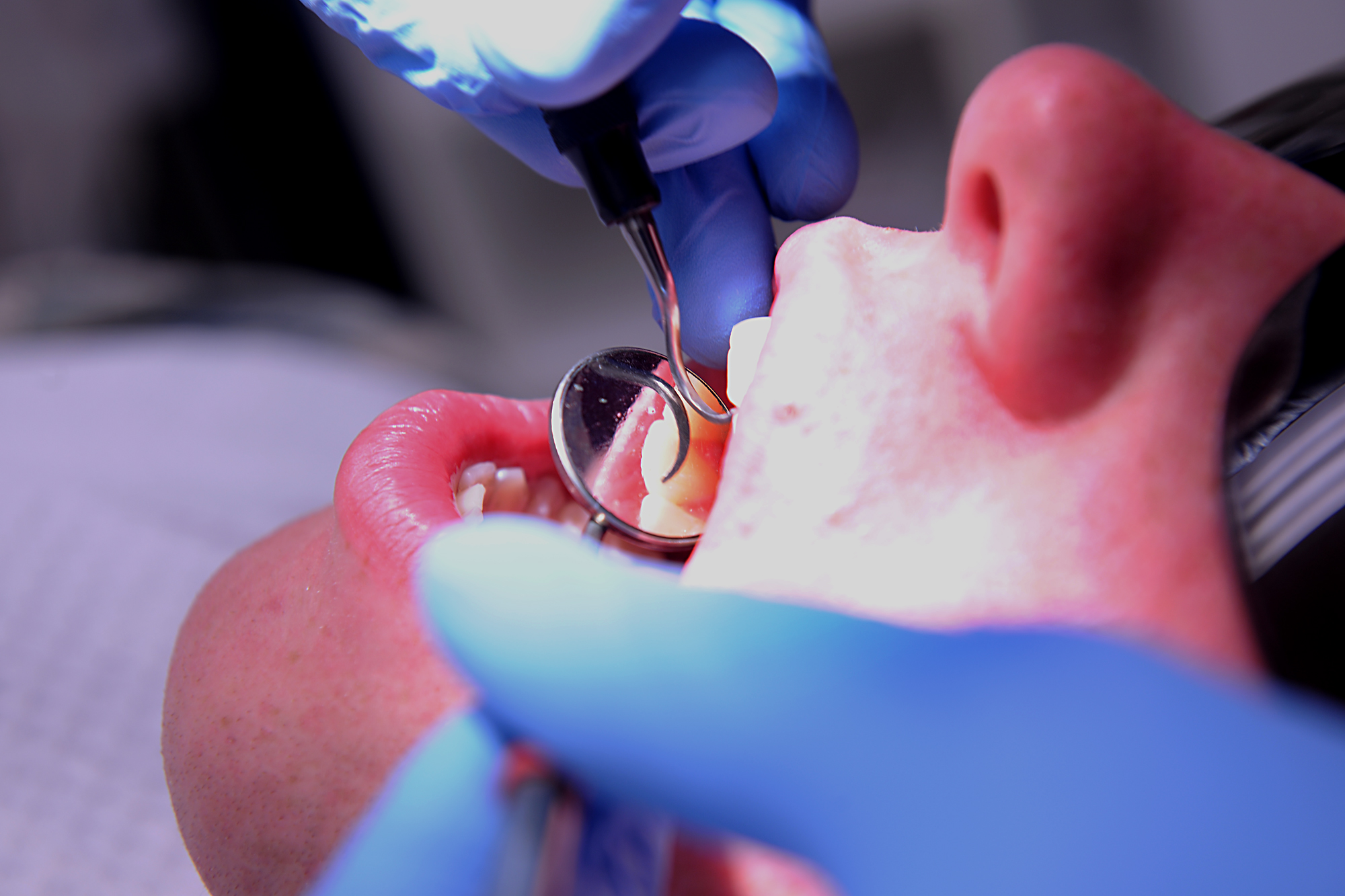 close up of a person having dental work done