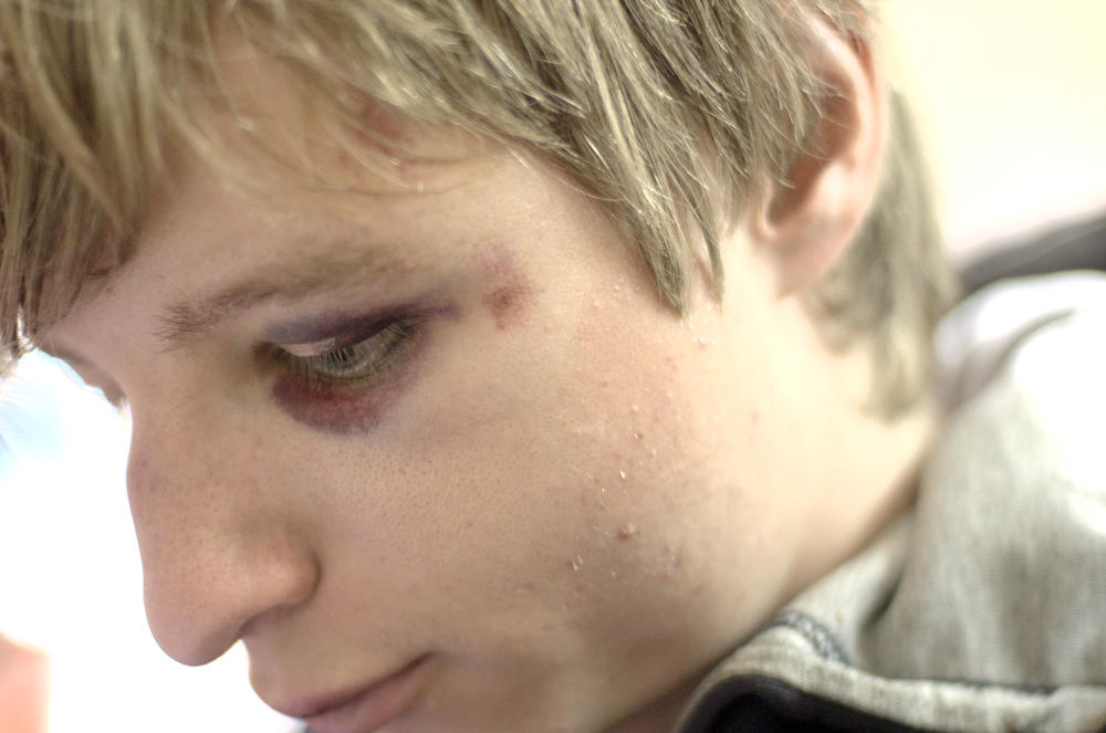 a close up image of a person with a bruised eye