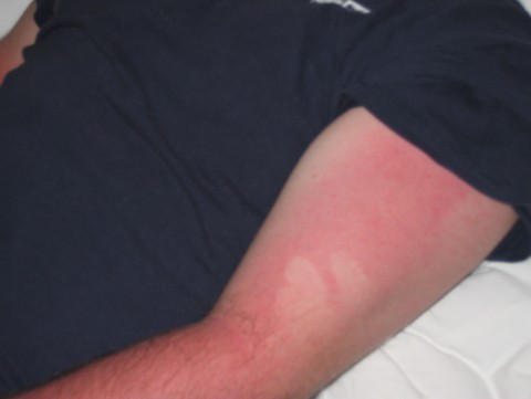 someone laying in bed with the sunburnt on