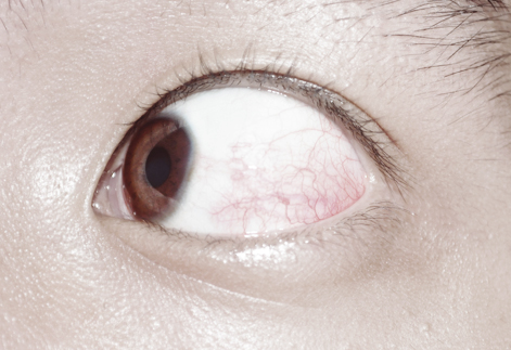 the eye of a young man with an acne and white patches