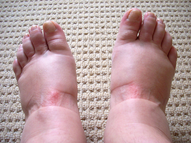 a foot that has a lot of red patches on it