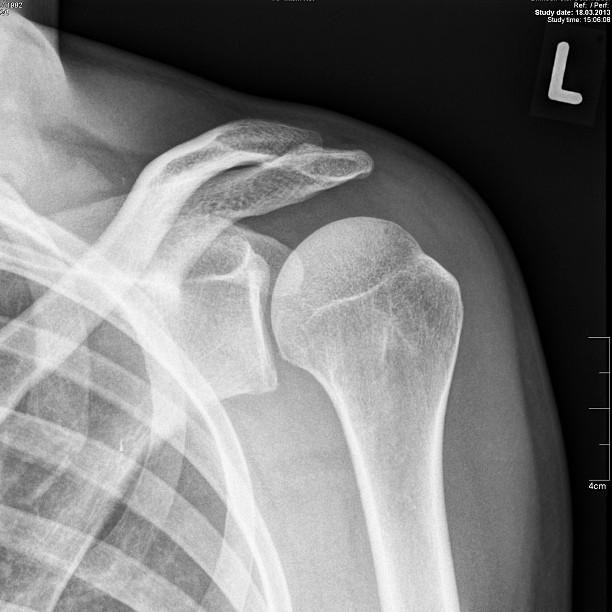 the x - ray shows an arrow pointing to the left