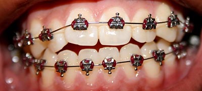 dental bridges mounted to the upper and lower teeth
