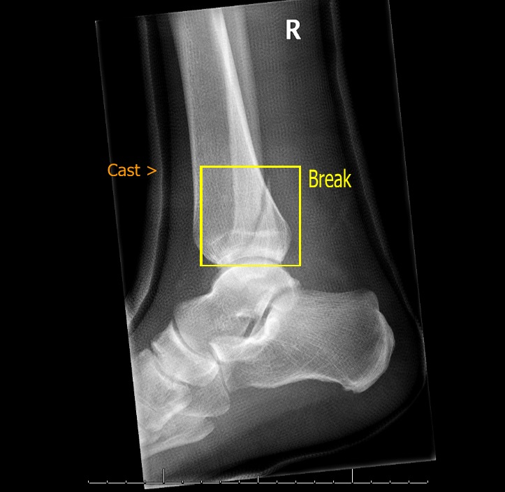 an x - ray shows a broken foot with white dots