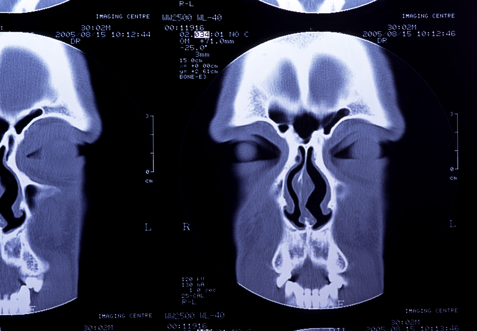 a computer scan shows two views of the skull