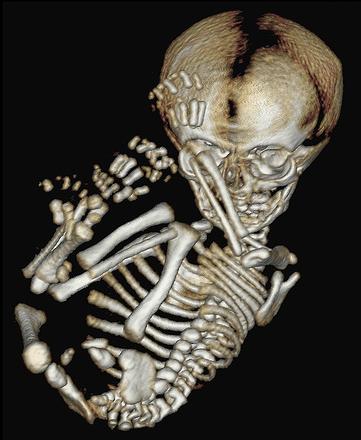 an image of a human skeleton lying on the ground
