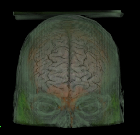 the mri image of a human's in shows a central part of the cranium and two smaller areas