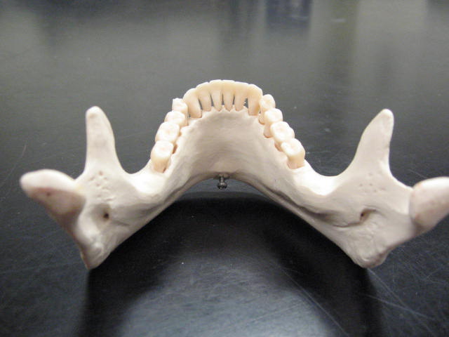 a model of a teeth that are missing their fangs