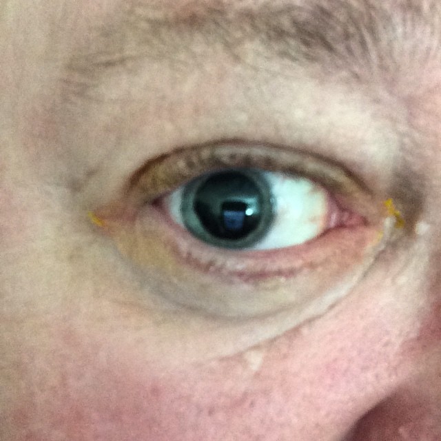 close up of an eye with an orange spot
