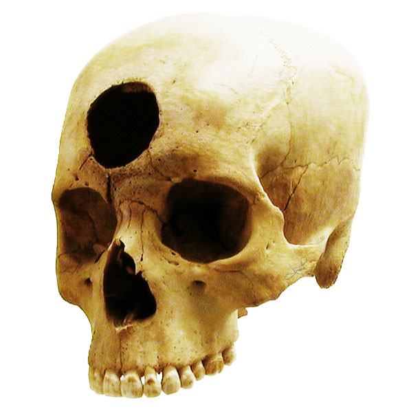 a human skull with small teeth and no visible teeth