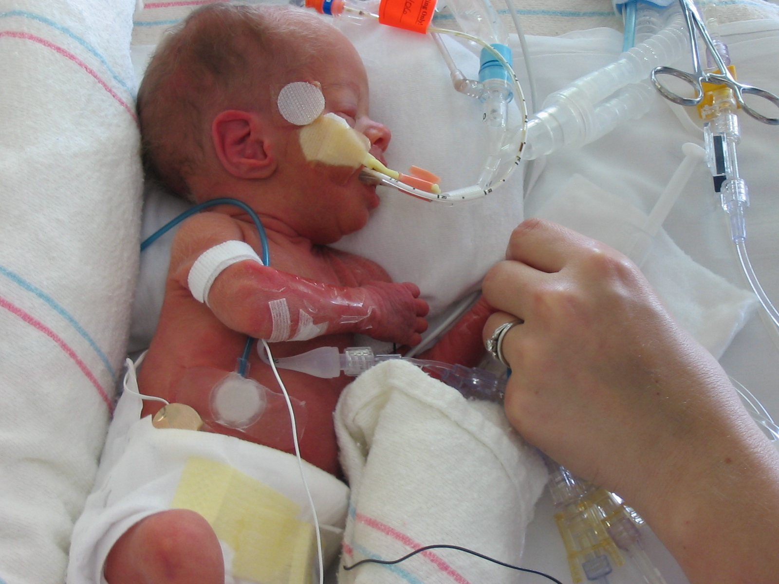 a baby being hooked up with oxygen in its mouth