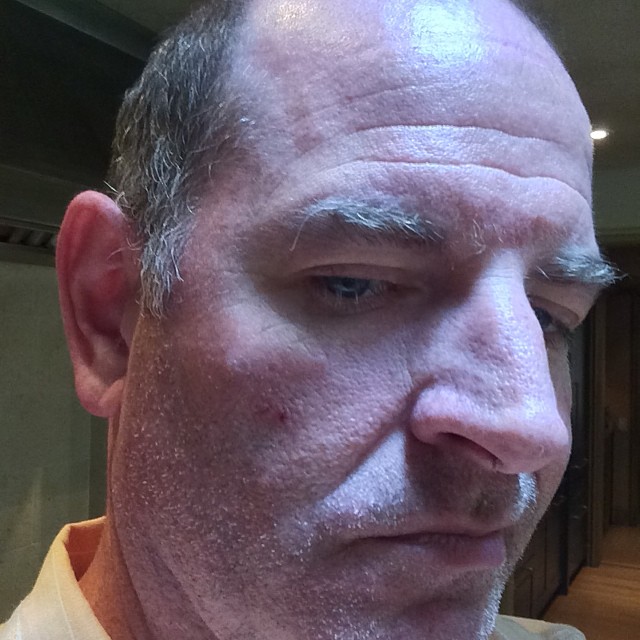 a man with white spots on his skin looks at the camera