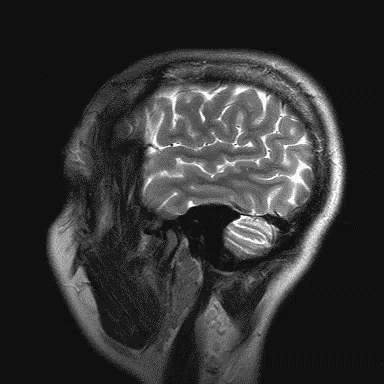 the in in black and white with an mri cutaway