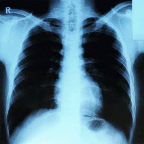 an x - ray of a chest with two ribs