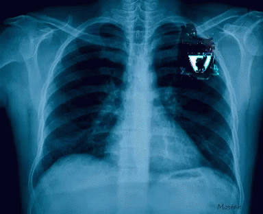 chest x - ray showing abnormal  location