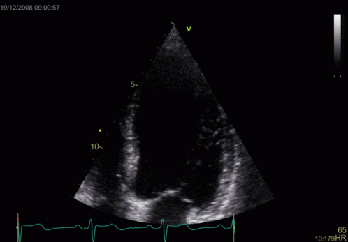 a triangle showing a small pulse as a normal heart rate
