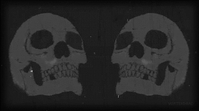two mri images of a skull showing its frontal side