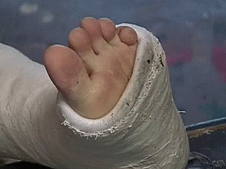 a blue foot is being worn with a cast