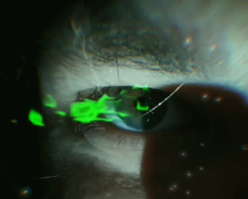 a reflection in the side of a persons eye