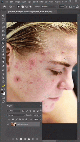 a woman with acne and a hair brush is featured