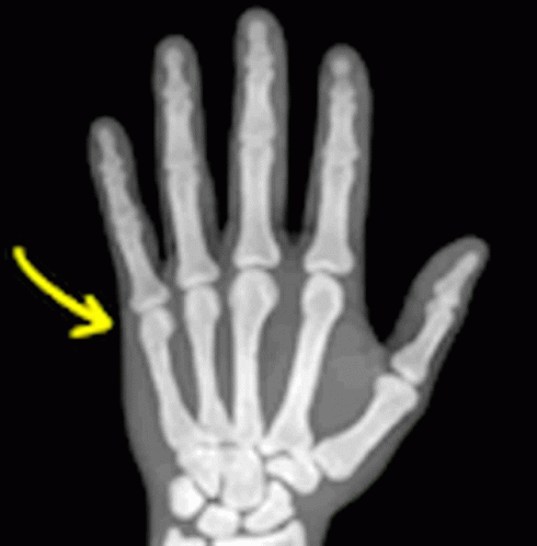 an x - ray po of a hand showing the left hand and right hand