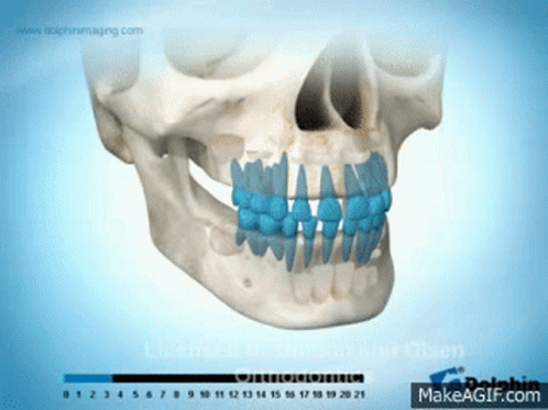 a model of a human's jaw with teeth missing