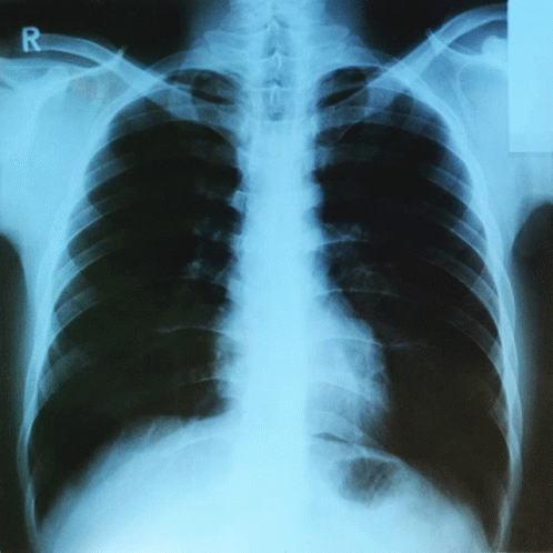 a pograph of an x - ray in a hospital room